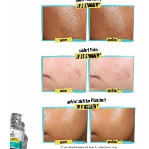 Kiehl's Truly Targeted Blemish Clearing Solution