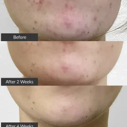 PMD Clean Clean Acne Elektrisches Gesichtsreinigungstool zur Behandlung von Akne von pmd.