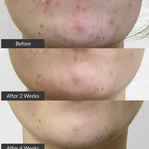 PMD Clean Clean Acne Elektrisches Gesichtsreinigungstool zur Behandlung von Akne von pmd.