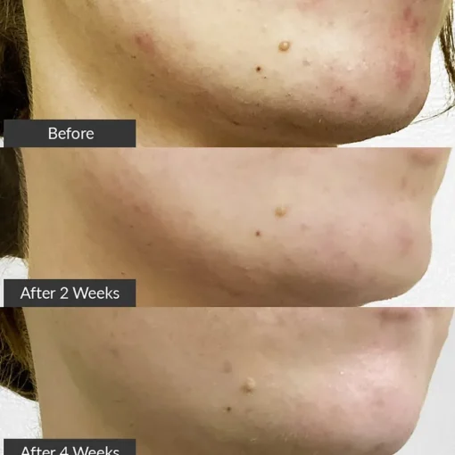 PMD Clean Clean Acne Elektrisches Gesichtsreinigungstool zur Behandlung von Akne von pmd.