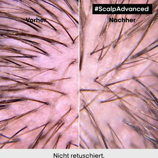 Serie Expert Scalp Advanced Anti-Discomfort Intense Soother Treatment von L’Oréal Professionnel Paris