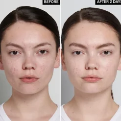 The INKEY List Succinic Acid Treatment