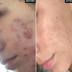 The INKEY List Succinic Acid Treatment